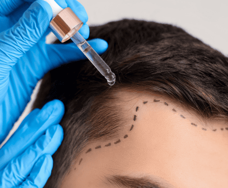 5. paziente soddisfatto dopo trapianto capelli Albania